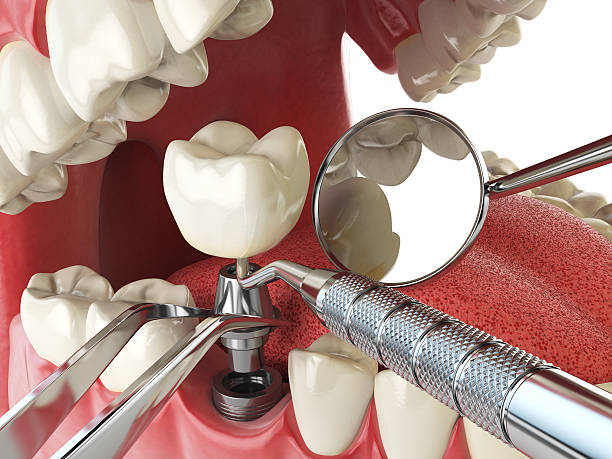 Best Root Canal Emergency Dentist  in South Patrick Shores, FL